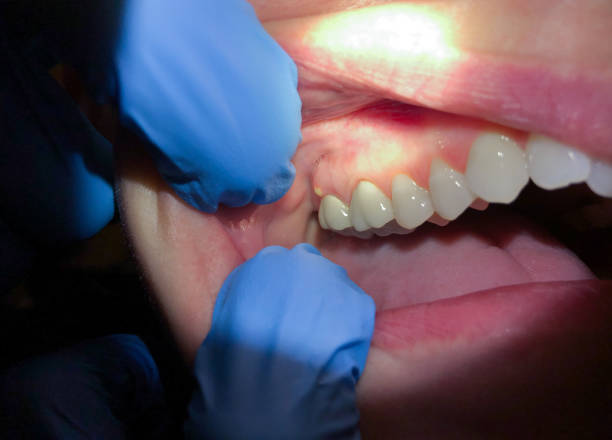 Best Emergency Wisdom Teeth Removal in Shippensburg, PA